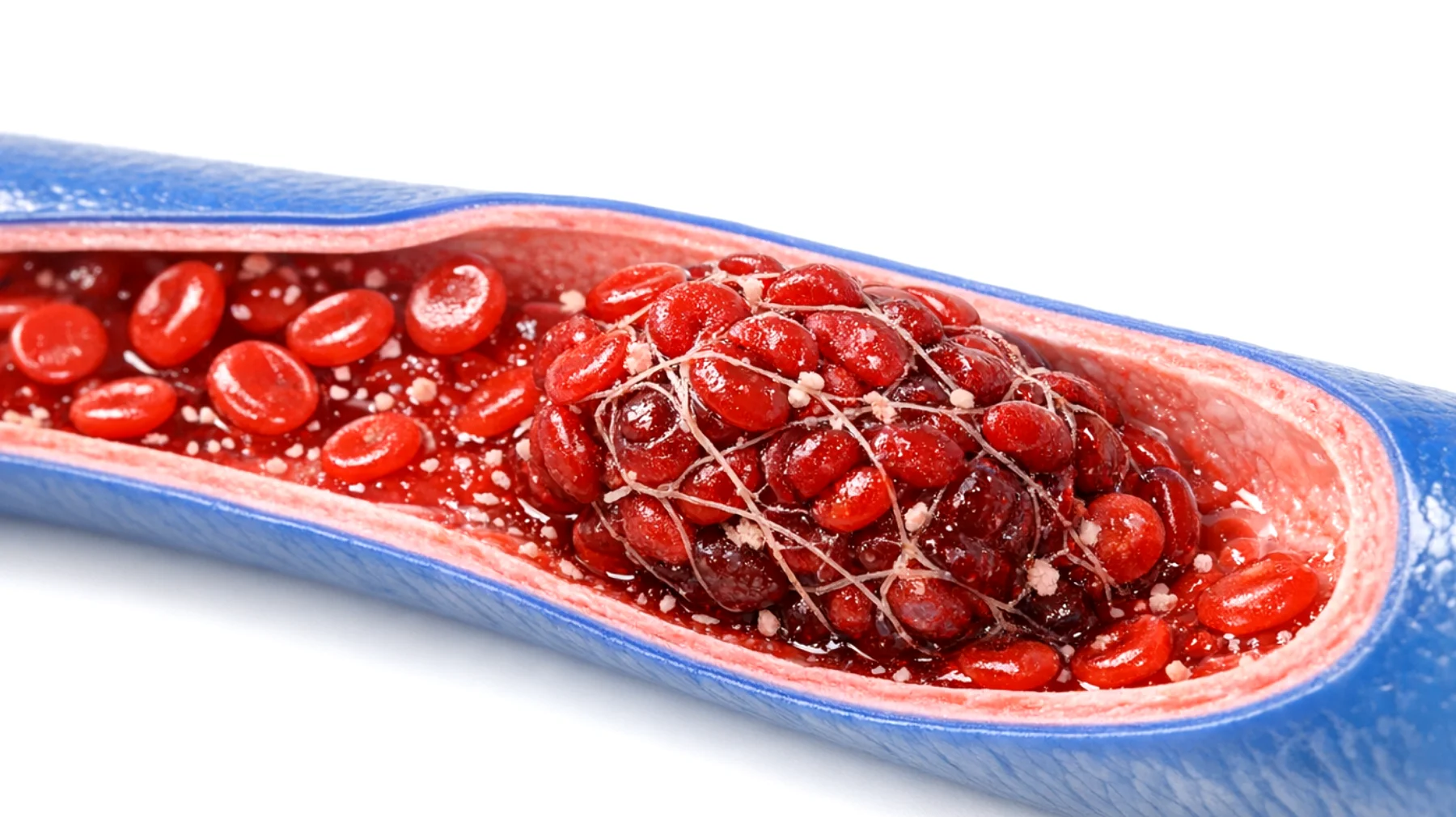 Zakrzepica: czy naprawdę jest zdrowa? Analiza faktów i mitów na temat tego schorzenia układu krążenia"