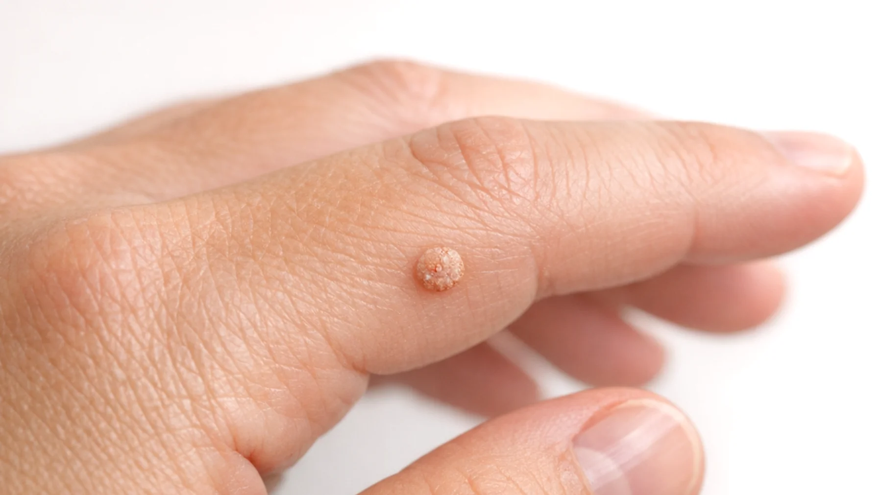 Brodawki: czy naprawdę są zdrowe? Prawda o tym powszechnym schorzeniu skóry"